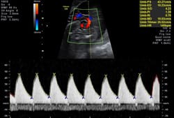 妊娠中期から末期の超音波検査